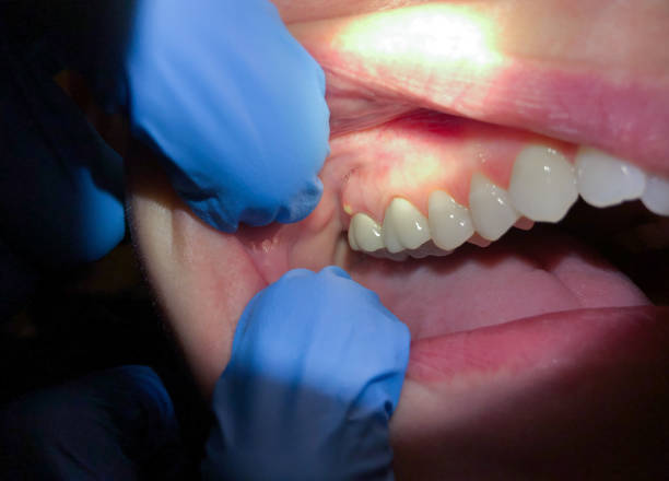 Best Emergency Dental Care for Broken or Chipped Teeth in Wernersville, PA